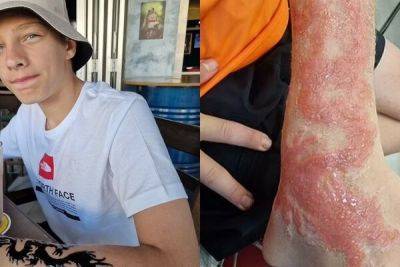 13-летний британец получил ожоги после татуировки на Кипре - cyprusbutterfly.com.cy - Кипр